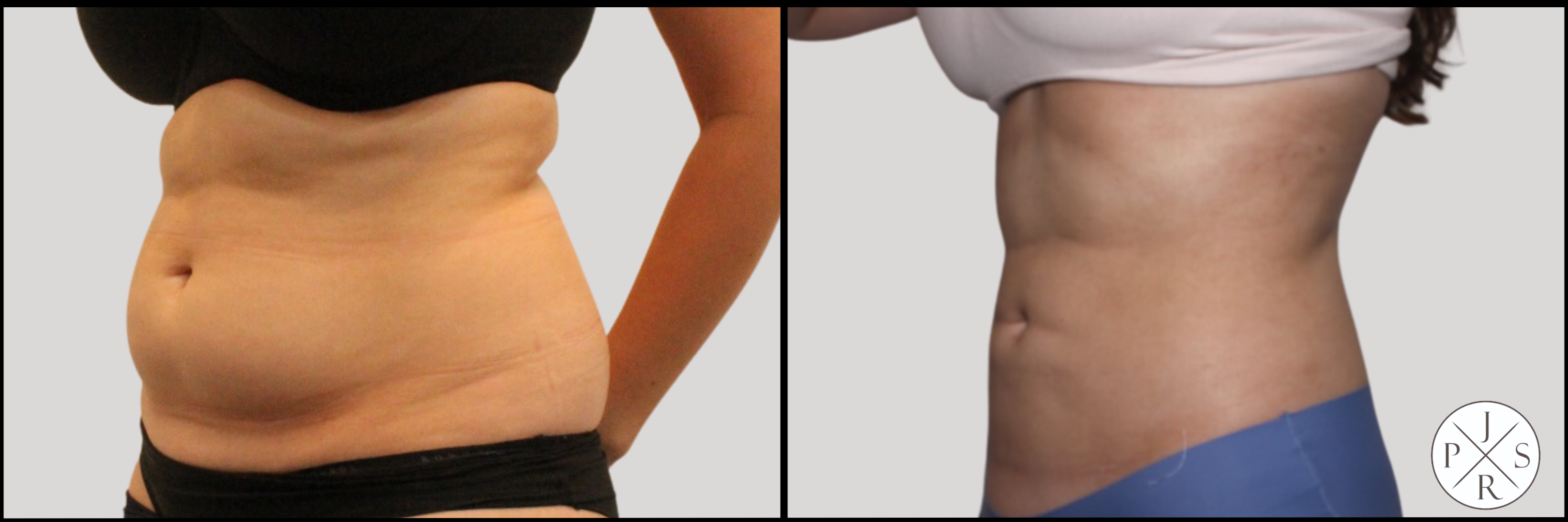 Liposuction Before & After Image